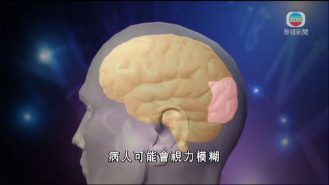 醫療:腦癌 醫療:腦癌