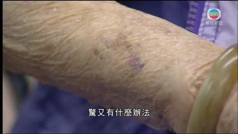 醫療:長者血斑 醫療:長者血斑
