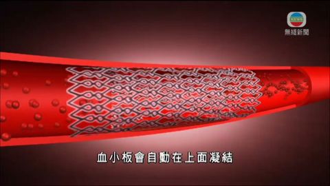 醫療:「通波仔」手術 醫療:「通波仔」手術