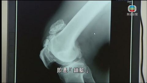 醫療:「膝頭老鼠」 醫療:「膝頭老鼠」