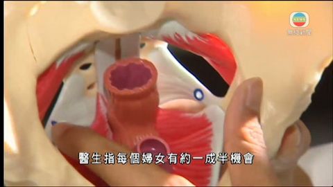 醫療：子宮下垂
