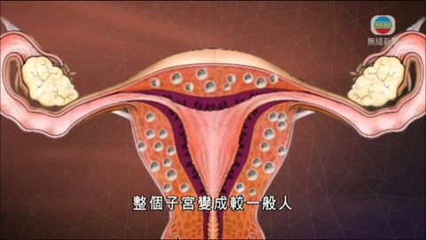 醫療:子宮肌腺瘤 醫療:子宮肌腺瘤