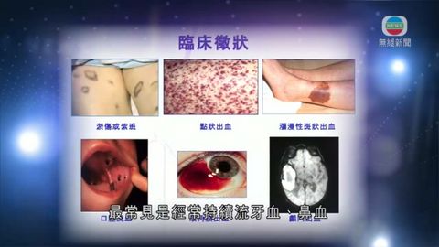 醫療:新療法助紫斑症病人減副作用 醫療:新療法助紫斑症病人減副作用