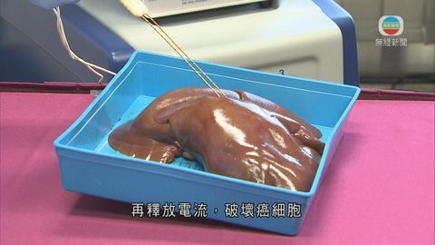 中大以納米刀技術治療腫瘤