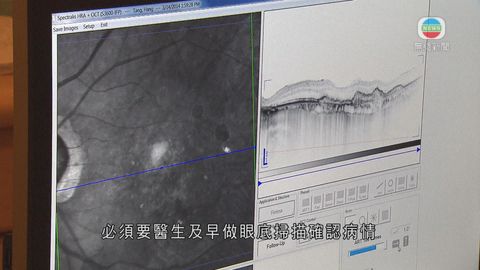 醫療:黃斑病變 醫療:黃斑病變