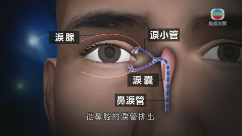 醫療:鼻淚管閉塞 醫療:鼻淚管閉塞