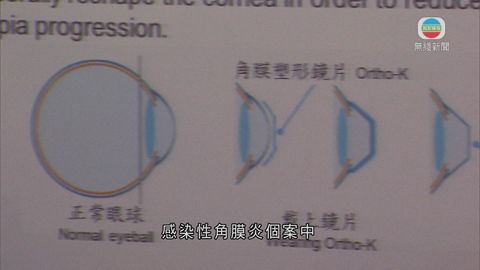 研究指「OK鏡」增性角膜炎感染風險