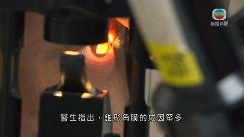 醫療：錐形角膜