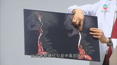 中大：頸動脈置支架減放射治療中風風險