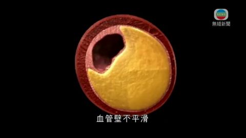 醫療:膽固醇超標 醫療:膽固醇超標