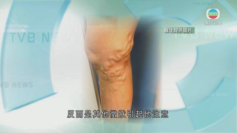 醫療:靜脈曲張 醫療:靜脈曲張