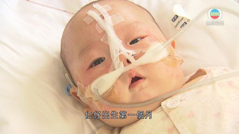 醫療:嬰兒面型異常或導致睡眠窒息症 醫療:嬰兒面型異常或導致睡眠窒息症
