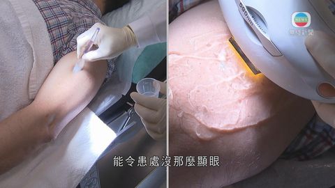 醫療:毛囊角化症 估計港一半人患病 醫療:毛囊角化症 估計港一半人患病
