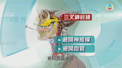 醫療：注射麻醉藥或令神經線受損