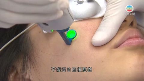 醫療:患玫瑰痤瘡者若不及早治療難復原貌 醫療:患玫瑰痤瘡者若不及早治療難復原貌