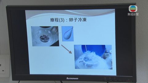 醫療:凍卵助婦科病患生育 新技術增成功率 醫療:凍卵助婦科病患生育 新技術增成功率