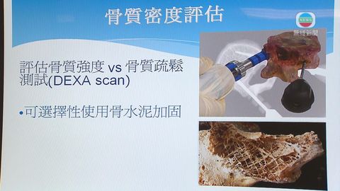 醫療:斷骨後或致骨質疏鬆 新技術助強化 醫療:斷骨後或致骨質疏鬆 新技術助強化