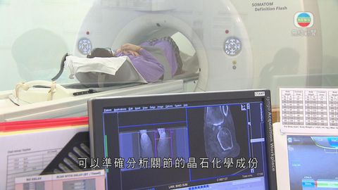 醫療:高尿酸釀痛風結石 新技術助及早斷症 醫療:高尿酸釀痛風結石 新技術助及早斷症