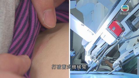 醫療：伊院引新型機械臂 微創治泌尿系統