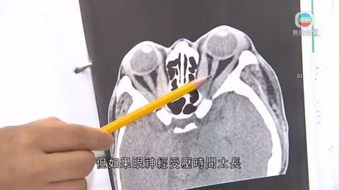 醫療:眼凸或致盲 內窺鏡手術或可恢復視力 醫療:眼凸或致盲 內窺鏡手術或可恢復視力