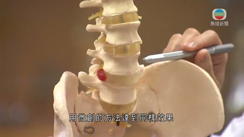 醫療:脊椎微創手術加快復康 翌日可出院 醫療:脊椎微創手術加快復康 翌日可出院