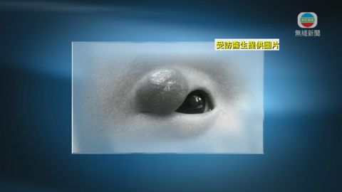 醫療:血管痣乃嬰兒常患良性瘤 留意發展 醫療:血管痣乃嬰兒常患良性瘤 留意發展