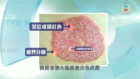 醫療室:銀屑病難根治 多運動助控制病情 醫療室:銀屑病難根治 多運動助控制病情