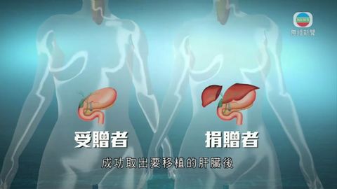 醫生指肝臟移植手術複雜 病人移植早成功率高 醫生指肝臟移植手術複雜 病人移植早成功率高