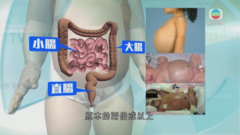 醫療：父母須觀察嬰兒排便 以防患上巨結腸症