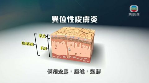 醫療:濕疹致皮膚痕癢 部分患者可接受光學治療 醫療:濕疹致皮膚痕癢 部分患者可接受光學治療