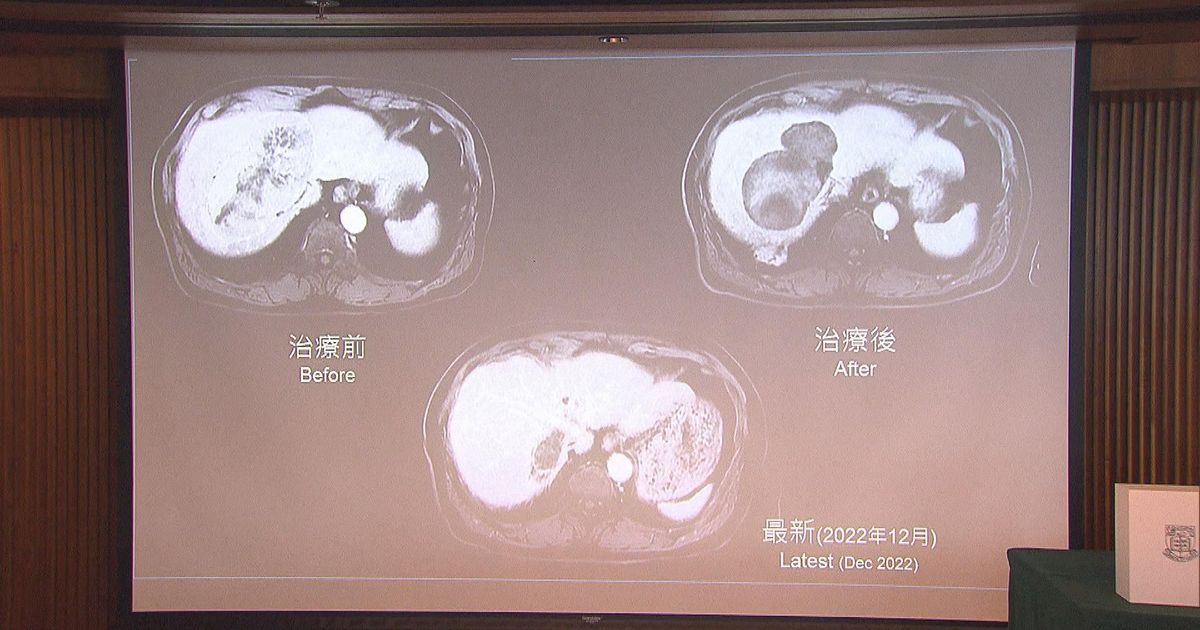 港大研治療中期肝癌新方案 先縮細腫瘤再配合手術等療程根治 無綫新聞tvb News