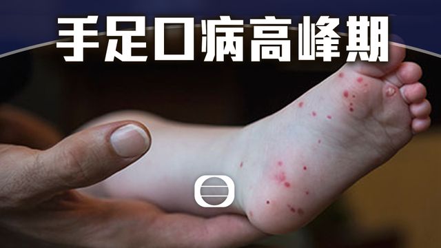 延伸閱讀|手足口病高峰期 注意個人衞生預防感染 延伸閱讀|手足口病高峰期 注意個人衞生預防感染