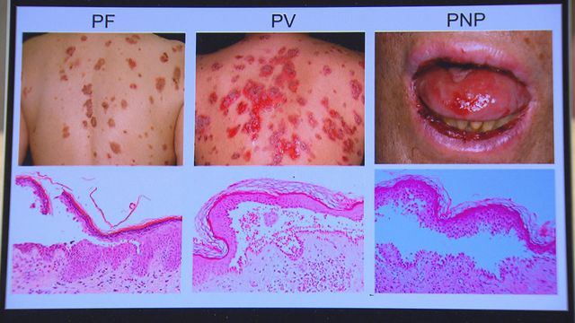 認識天皰瘡:類型、症狀、成因與風險因素|延伸閱讀‧最強生命線 認識天皰瘡:類型、症狀、成因與風險因素|延伸閱讀‧最強生命線