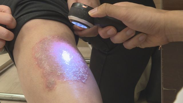 認識銀屑病非單純皮膚病　了解牛皮癬症狀與治療新方向｜最強生命線‧延伸閱讀