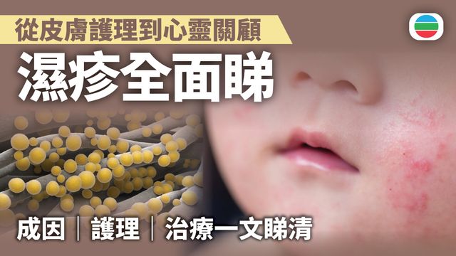濕疹全面睇：從皮膚護理到心靈關顧　拆解治療迷思｜延伸閱讀