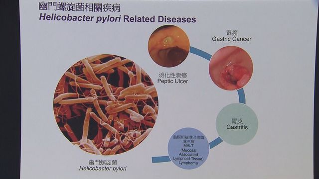 幽門螺旋菌：隱藏的胃部健康殺手〡延伸閱讀