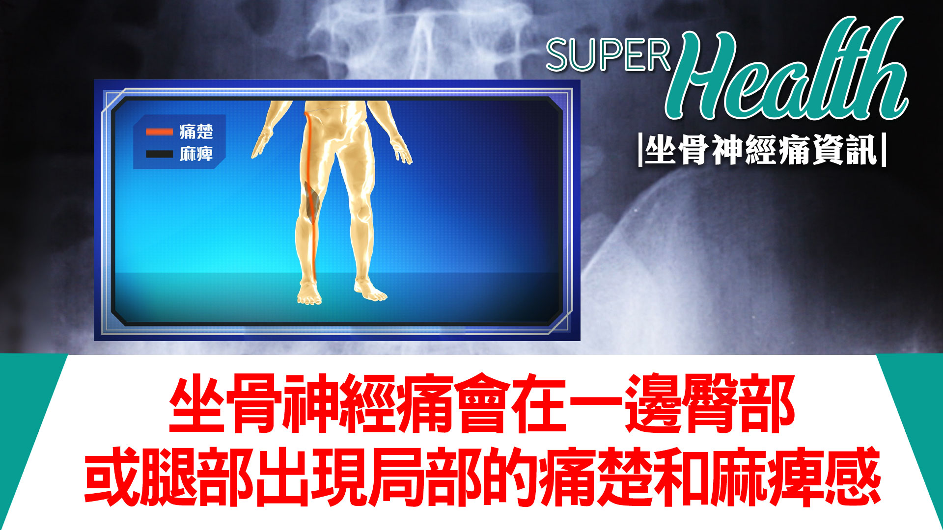 Sciatica Info Watch On Mytv Super